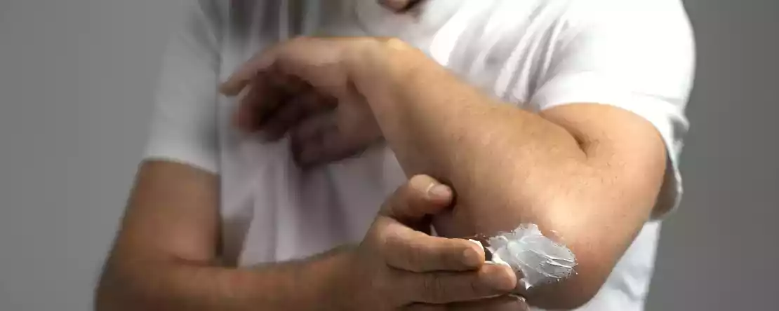 Правда ли, что сливочное масло смягчает небольшие ожоги?